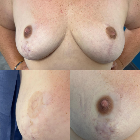 Redonnez forme et réalisme à votre poitrine grâce à nos prothèses d’aréoles en silicone 3D, sur mesure ou prêtes à porter, effet seconde peau garanti.