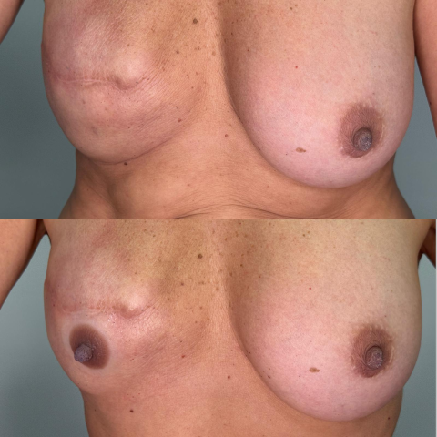 Redonnez forme et réalisme à votre poitrine grâce à nos prothèses d’aréoles en silicone 3D, sur mesure ou prêtes à porter, effet seconde peau garanti.